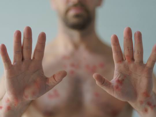 Em seis dias, MS registra aumento de 22,7% no número de casos de varíola dos macacos