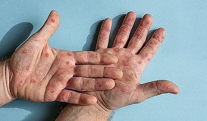 Adolescente de 16 anos está entre os seis novos casos de Monkeypox em MS