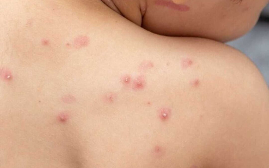 Mais 5 casos de varíola dos macacos são registrados em MS