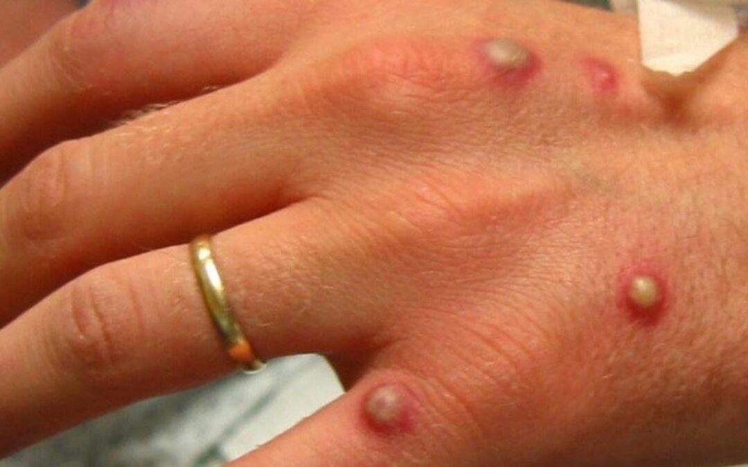 Número de mulheres infectadas pela varíola dos macacos em MS cresce