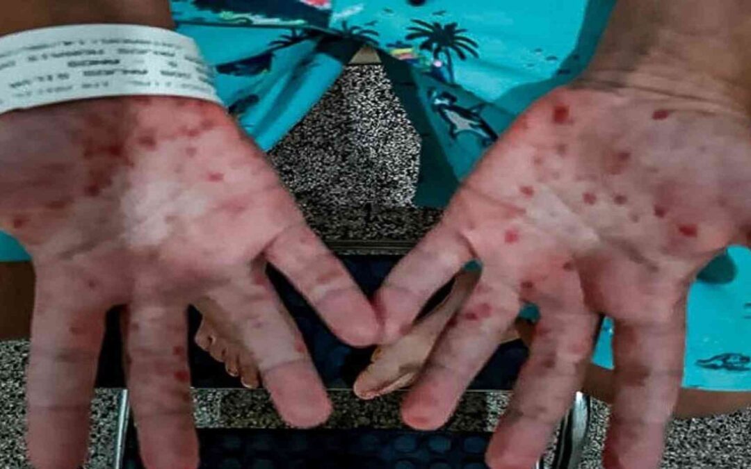 Secretaria de Educação confirma casos da doença mão-pé-boca em creches de Campo Grande