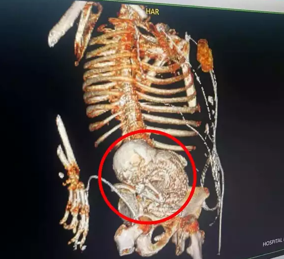 Mulher de 86 anos surpreende equipe médica ao descobrir feto mumificado em seu útero