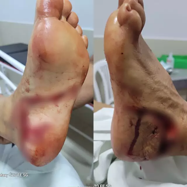 Bonito:Turista tem corte profundo no pé após levar mordida de dourado