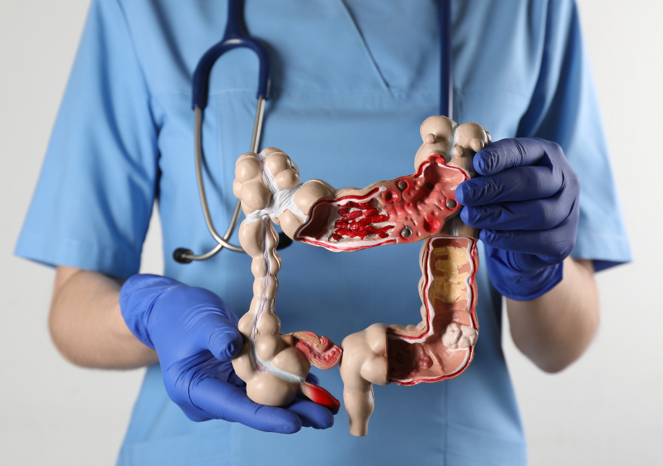 Especialista alerta para câncer de intestino: rastreamento deve começar aos 45 anos