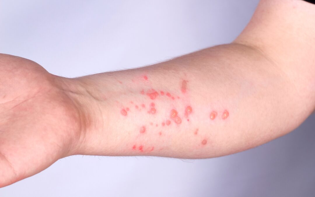 Capital tem dois casos suspeitos de mpox e um terceiro já descartado